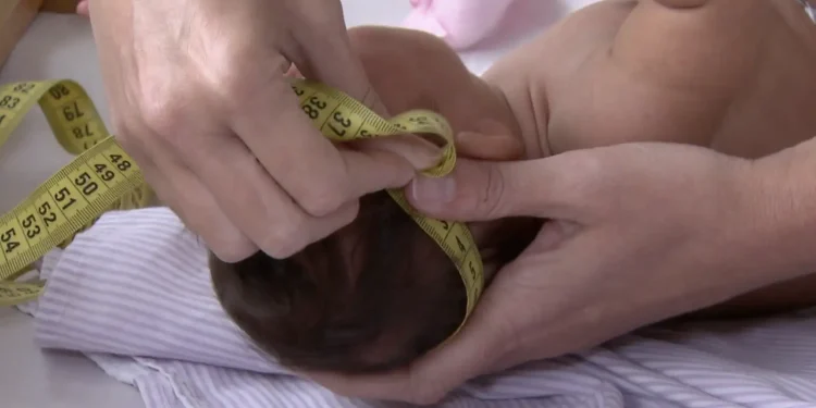 Bebe Com Microcefalia