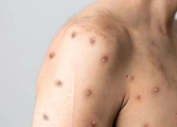 Mpox O Que E Sintomas Diagnostico E Tratamentos Eficazes