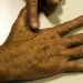 Cancer De Pele Melanoma20220520 0621