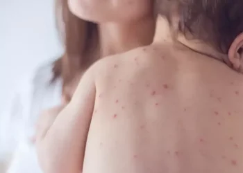 Sarampo 1