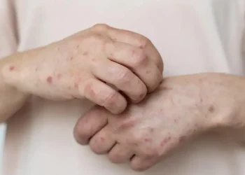 Sarampo