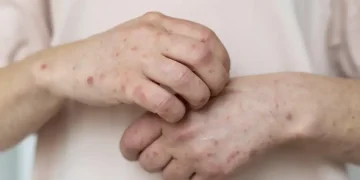 Sarampo